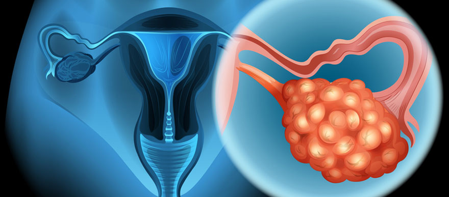 Consultation en oncologie gynécologique